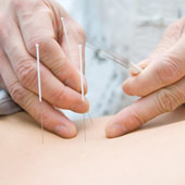 Akupunktur Nadeln - Energiemedizin